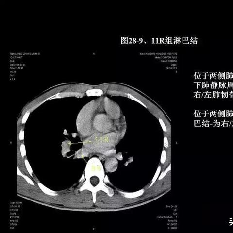 颈部淋巴结分区最新详解